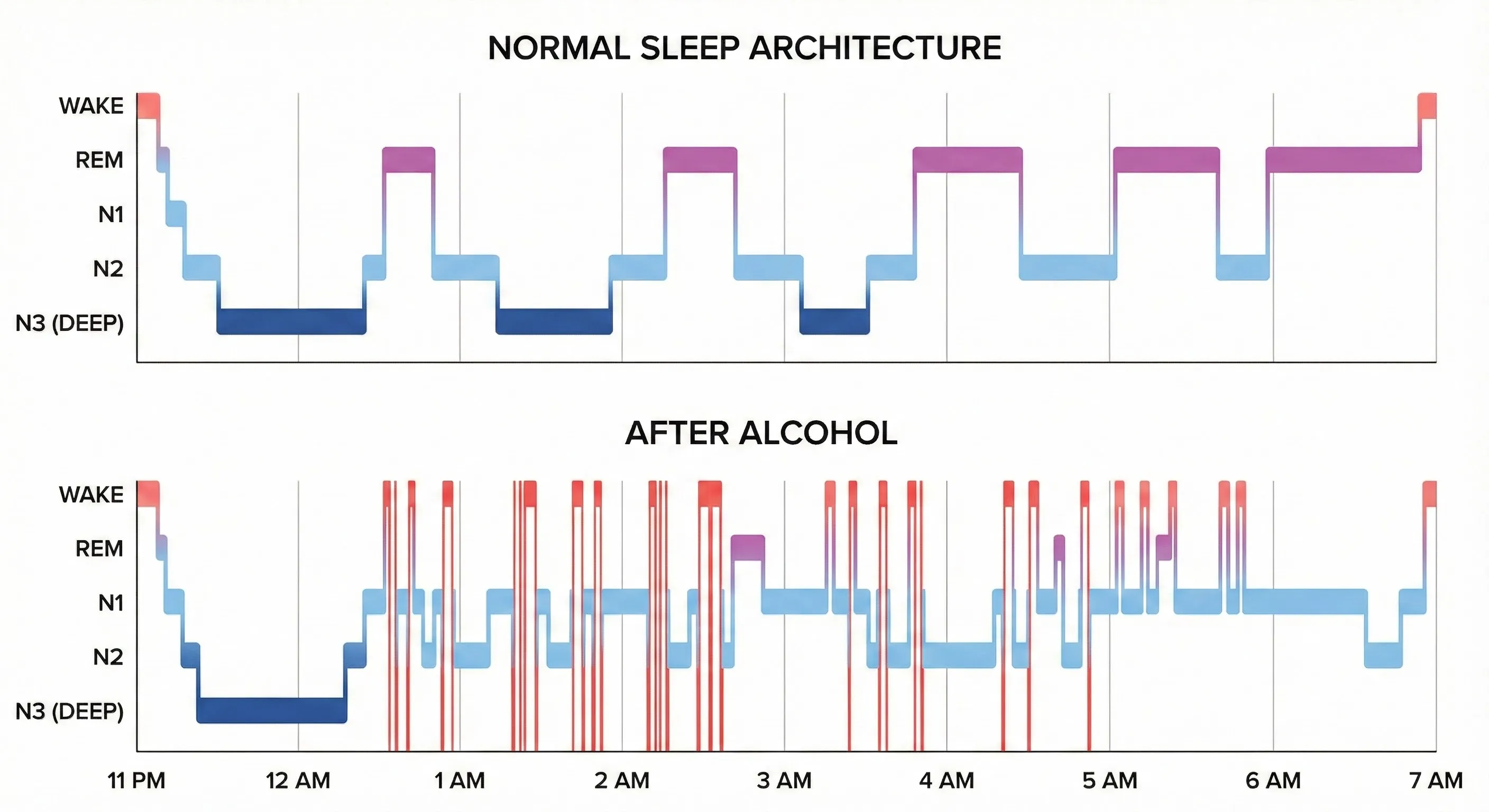 Sleep stage comparison showing alcohol's impact on sleep architecture