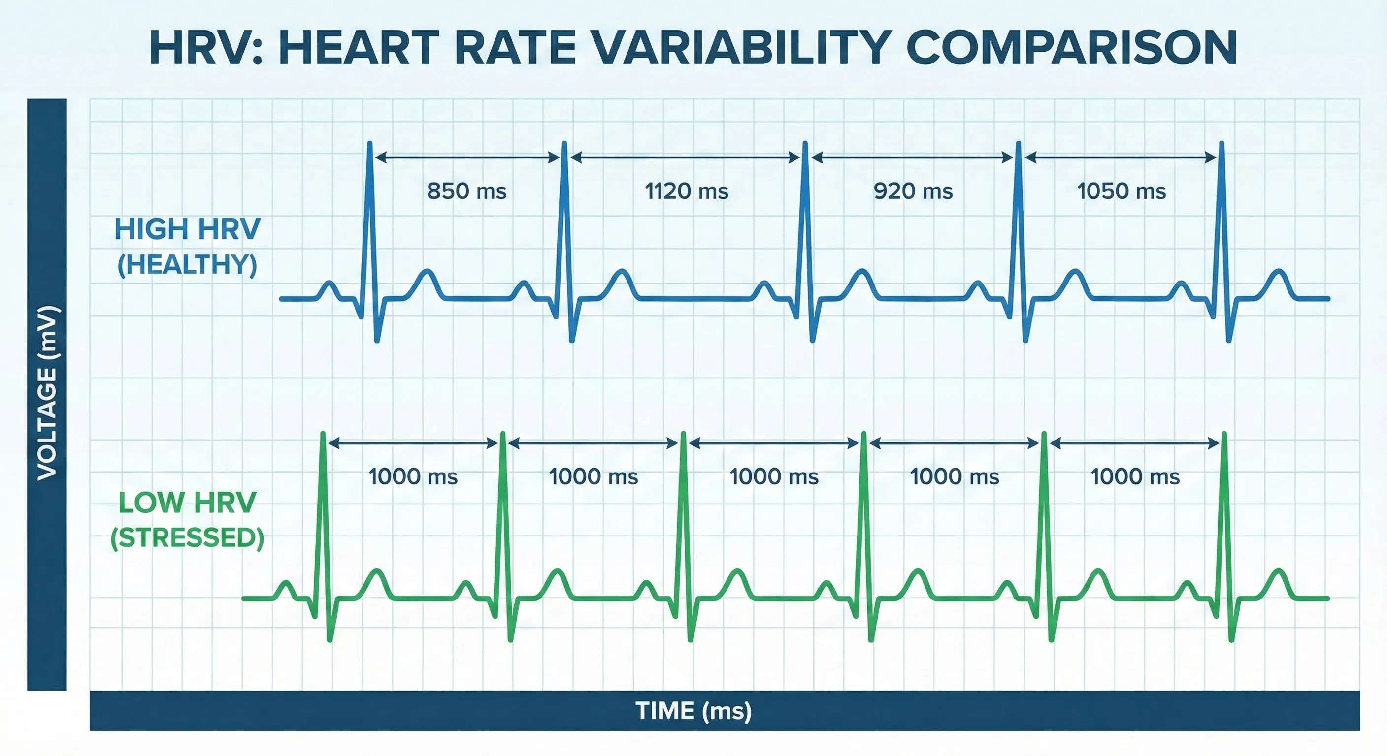 ECG trace showing variable R-R intervals between heartbeats
